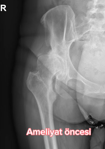 Op. Dr. Murat Kezer(Kalça&Diz Protezi, Halluks Valgus, Robotik Diz Protezi, Protez Revizyonu, Artroskopi)