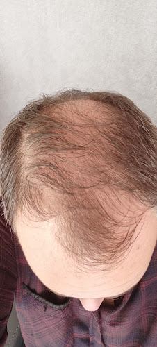 Prp Saç Tedavisi İzmir | Ossi Hair | İzmir Saç Ekim | İzmir Mezoterapi | PRP İzmir